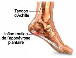 Douleur au niveau de la voute plantaire ou au niveau du tendon d'achille et si c'etait une myoaponevrosite plantaire???