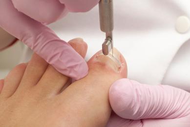 orthonyxie réalisée par un pédicure orthonyxie réalisée par un pédicure