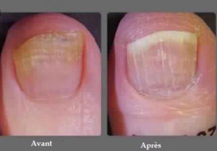 La mycose des pieds et des ongles :  Votre podologue à CLAMART peut vous renseigner !