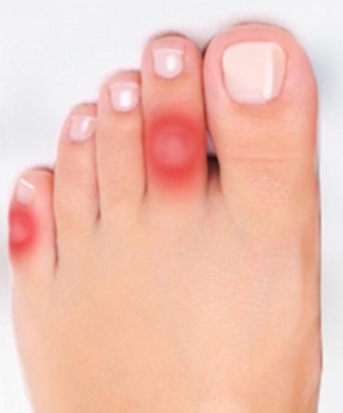 Les cors aux pieds : définitions et symptômes ! Que dois je faire?